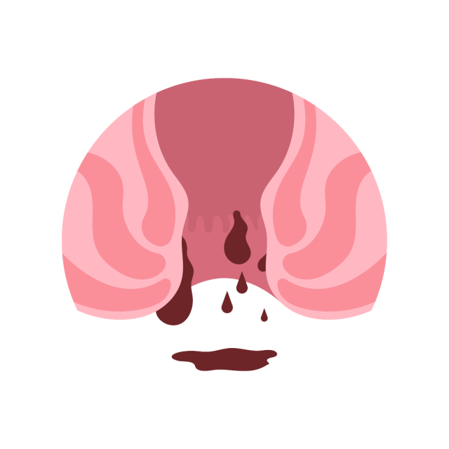 Anal Fissure 1