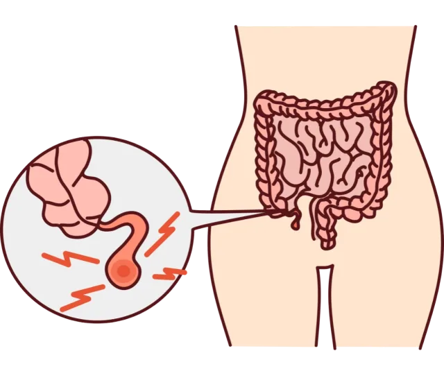 Appendicitis