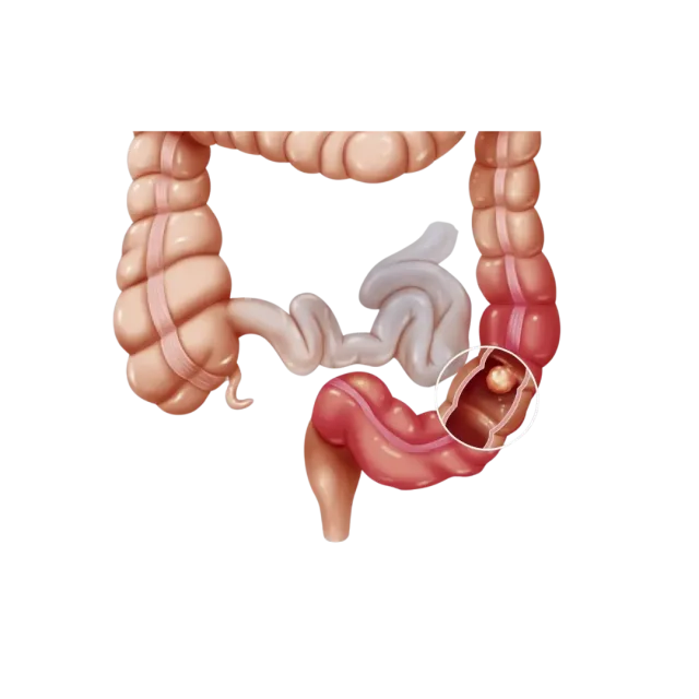 Bowel Obstruction Intestinal Obstruction 2 1