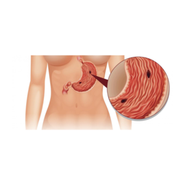 Bowel Perforation Intestinal Perforation 1