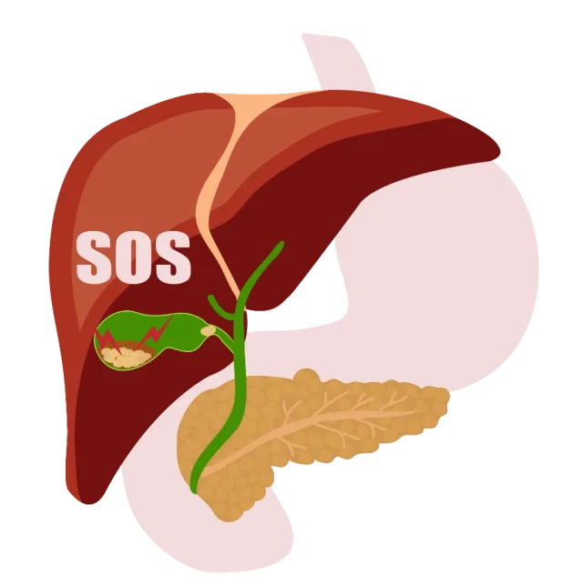 Cholelithiasis