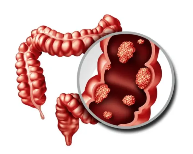 Colon Cancer