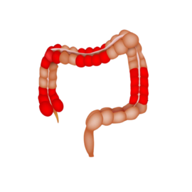 Crohns Disease 1