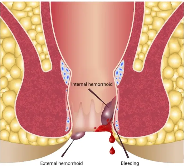 Haemorrhoids Or Piles