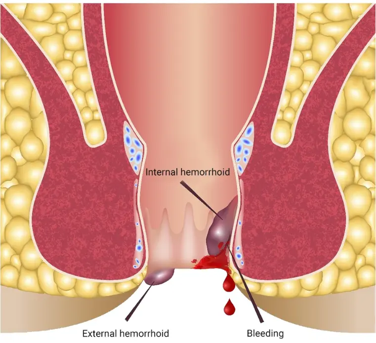 Haemorrhoids Or Piles