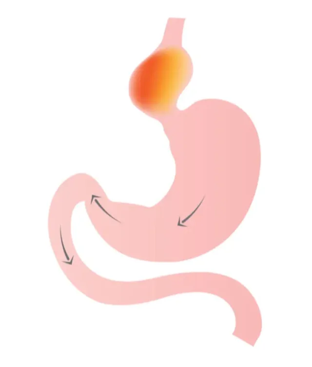 Hiatus Hernia 1