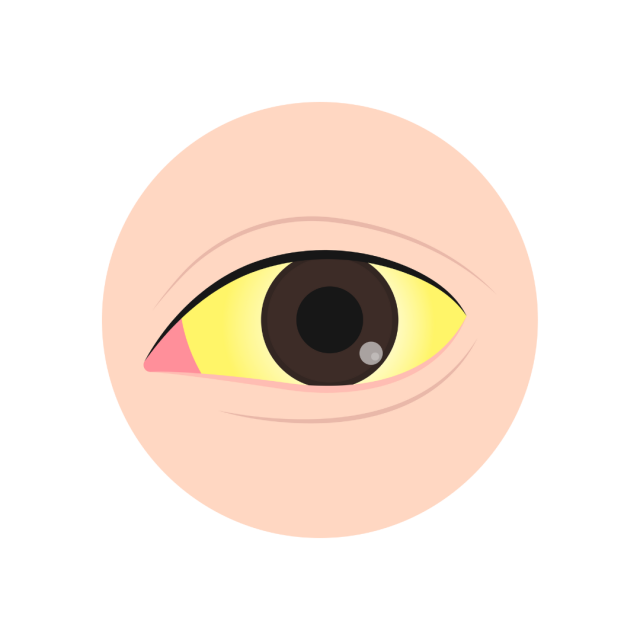 Jaundice
