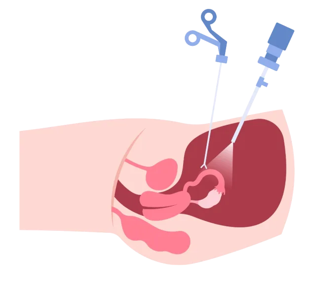 Laparoscopic Surgery