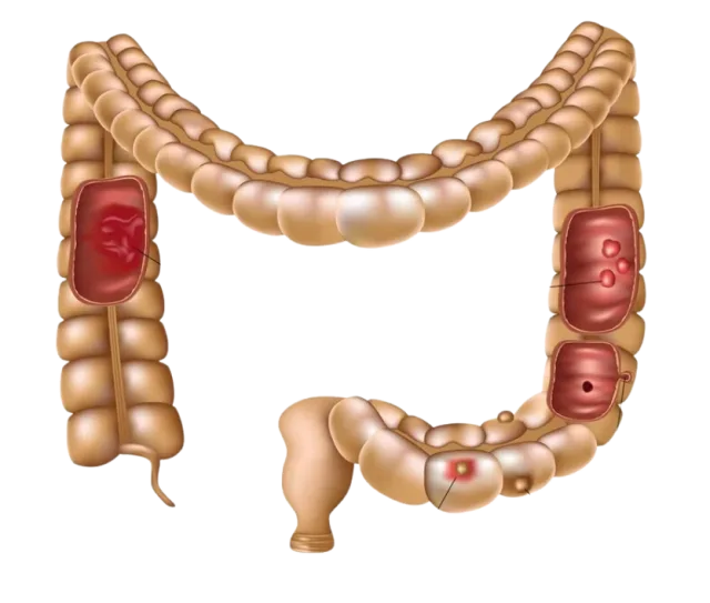 Large Intestine Colon Disorders