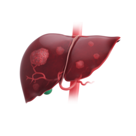 Liver Cancer Hepatoma 1