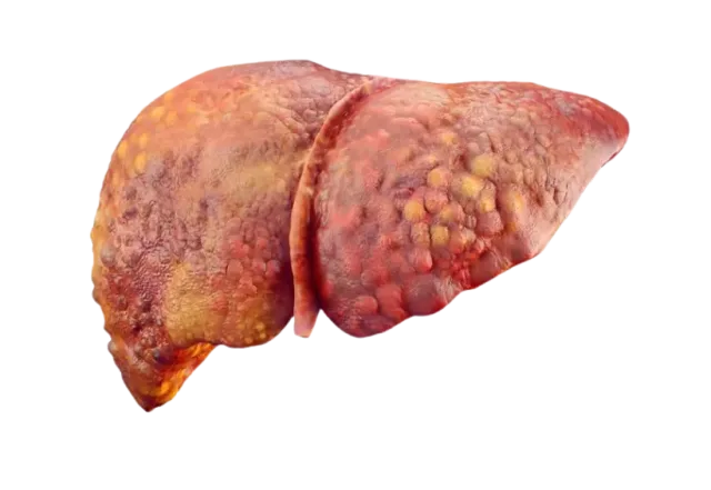 Liver Cirrhosis 2