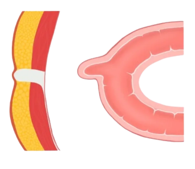 Meckels Diverticulum
