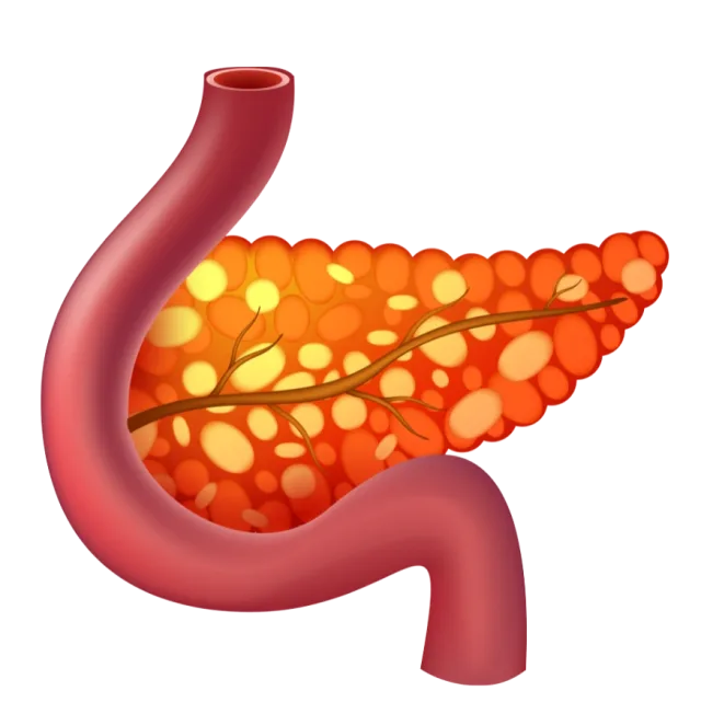 Pancreatitis 1