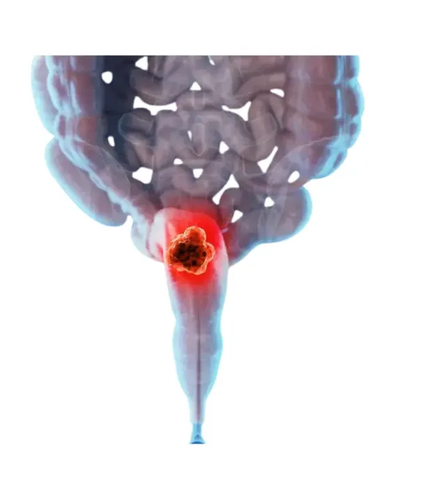 Rectal Cancer
