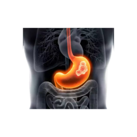 Stomach cancer 1
