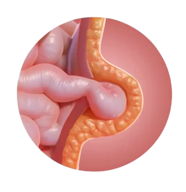 Umbilical Hernia