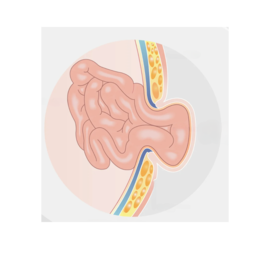 Ventral HerniaIncisional Hernia 2